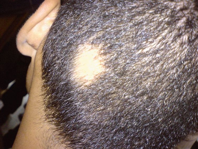 alopecia areata hoofd